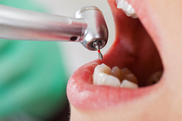Best Emergency Dentist for Knocked-Out Tooth in Richland, WA
